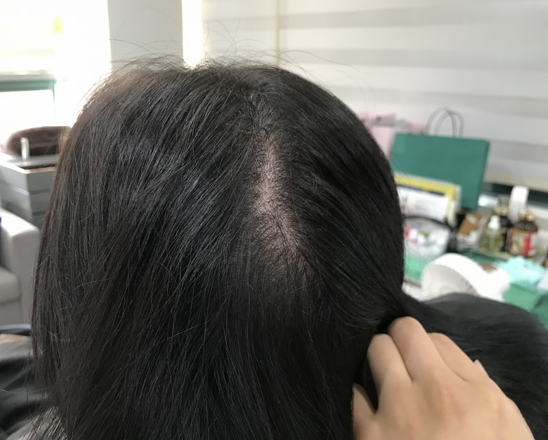 먹는 미녹시딜 여성 6주차 입니다