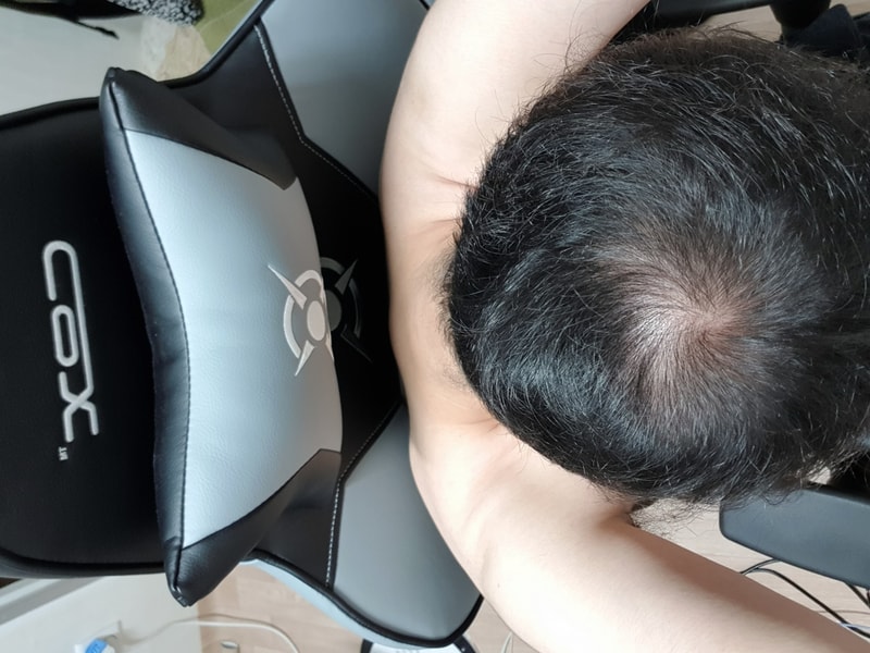 Propecia 6 Months Minoxidil 1 Month