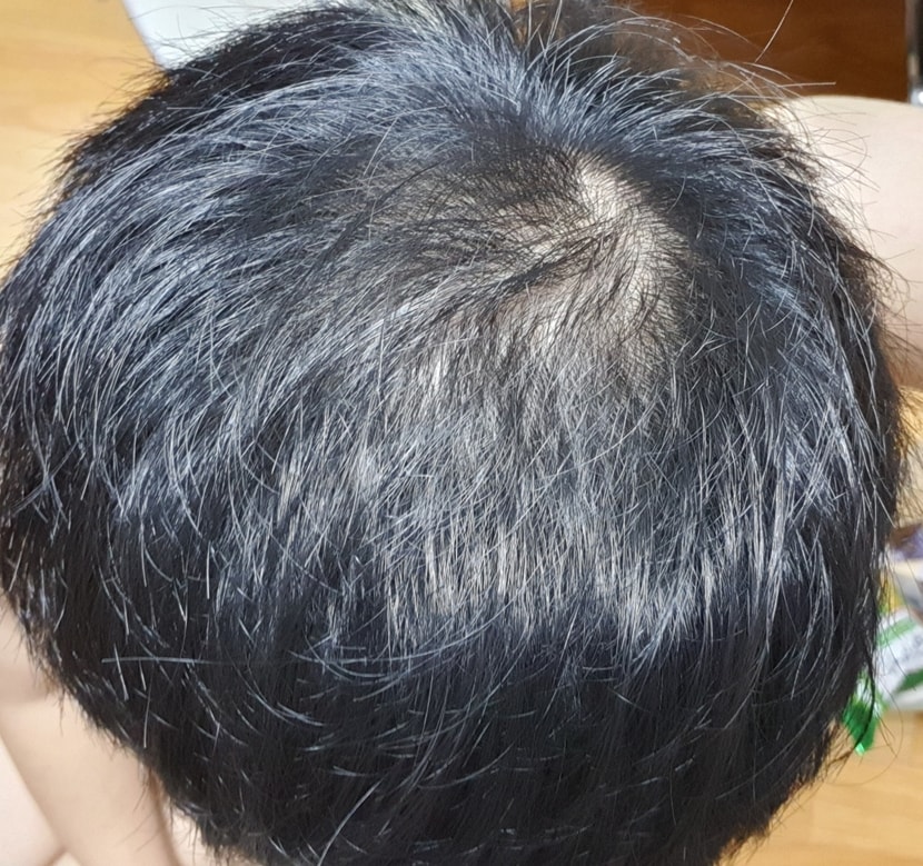 약복용후 2.5개월 후