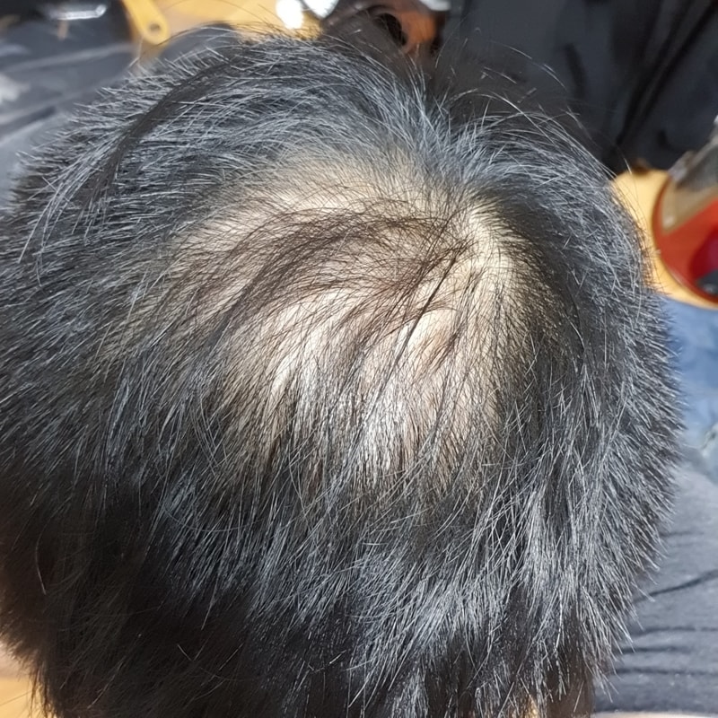 Propecia + Minoxidil 复合处方 2.5个月后期