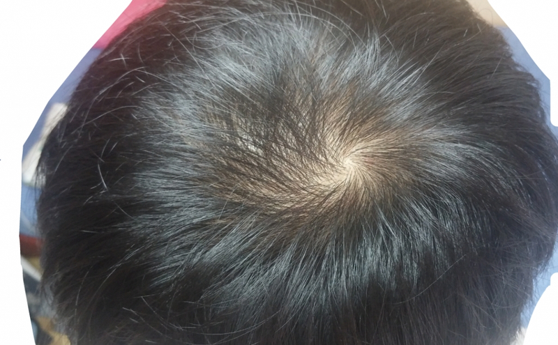 카피약 복용 6일차!