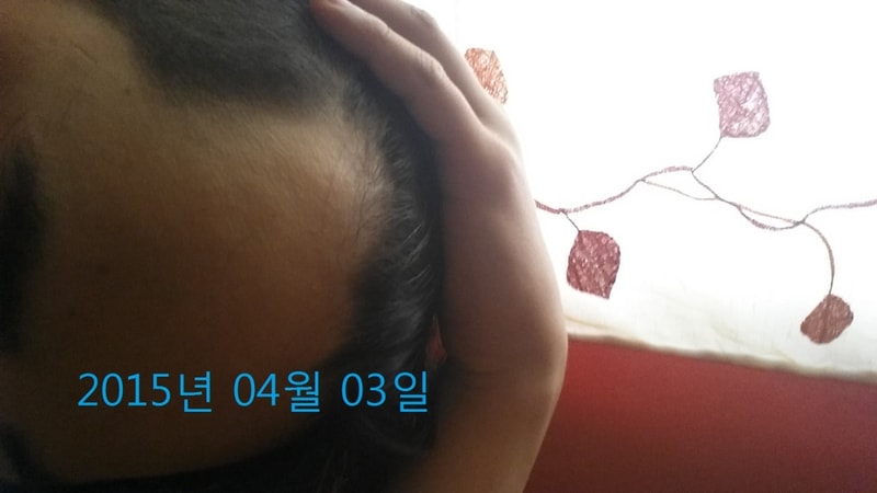 프로스카 4등분 약 1년6개월 복용 후기...절망적입니다 죽고싶네요