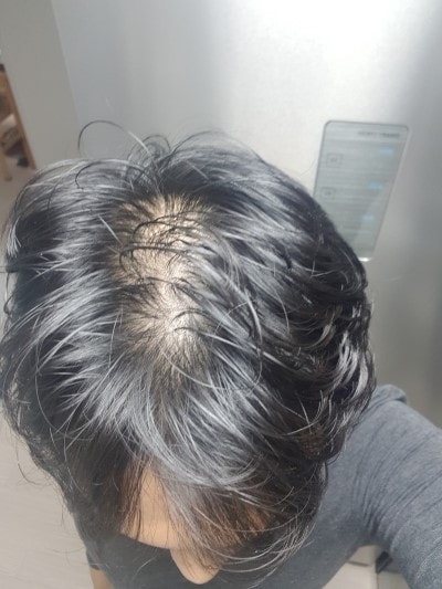 2018.11.10(미녹시딜 도포후찍었는데 머리숱이 좀 더없어보이네요)