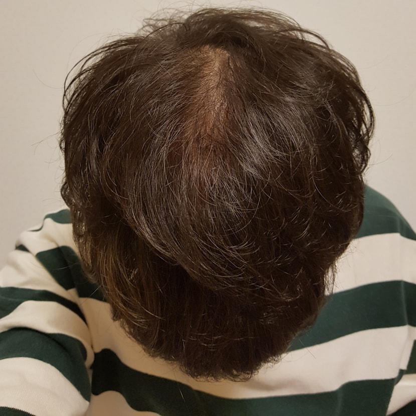 92일 정수리 (앞)