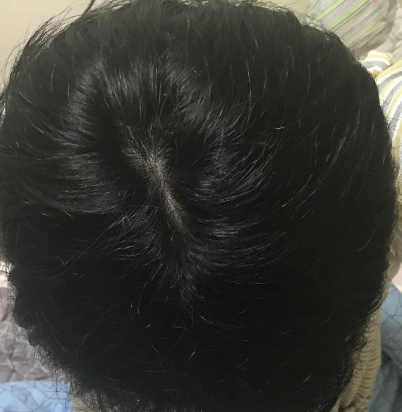 탈모약 약 8개월 복약.