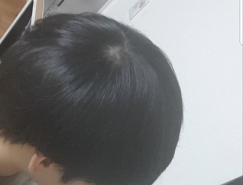 어제찍은 정수리사진입니다 정상 인지 비정상인지는 모르겠네요 예전보단 나아진듯합니다