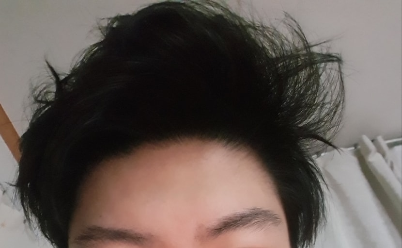 앞머리사진입니다 m자가 없어졌는지는 모르겠는데 전문가가아니라서 잘모르겠네요