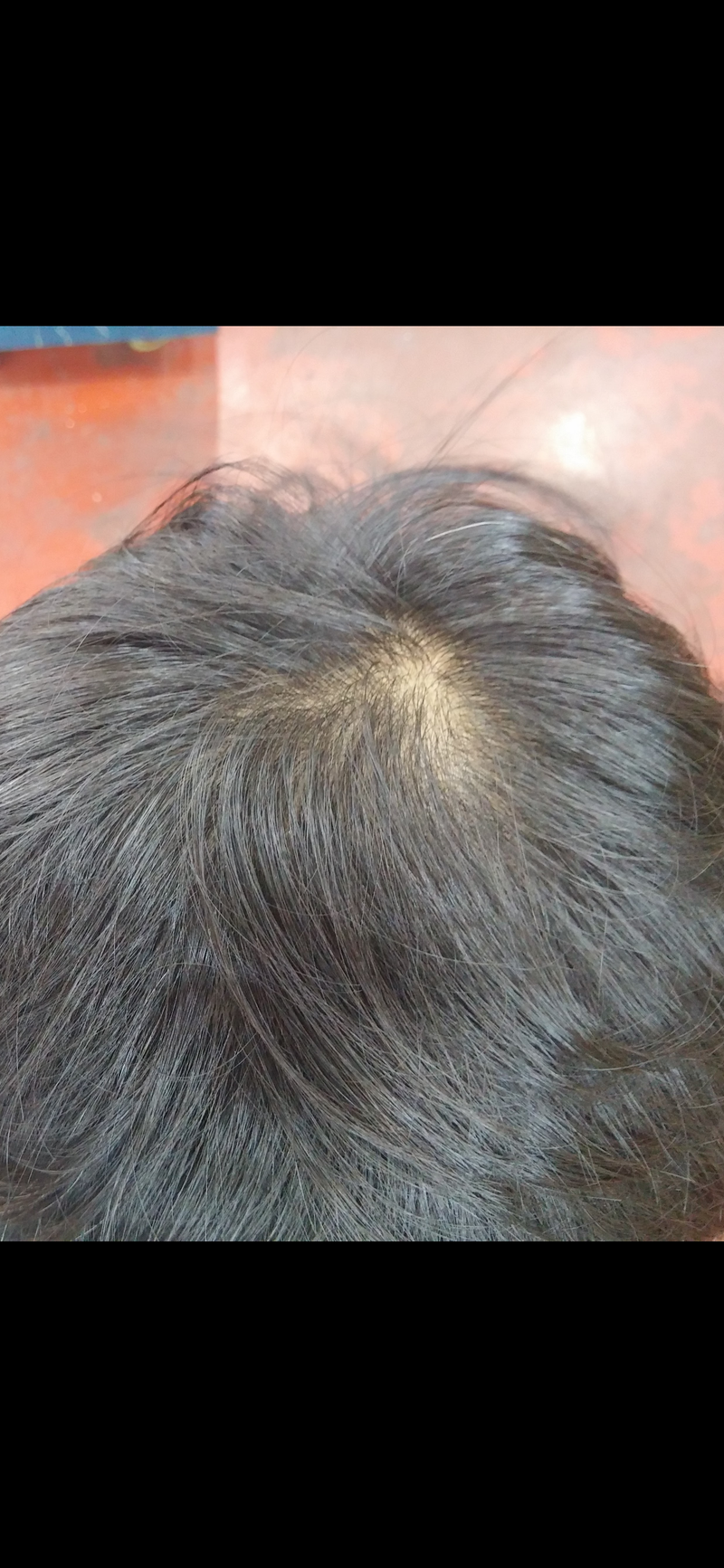 This is a photo from year to year before applying minoxidil and after I started applying it