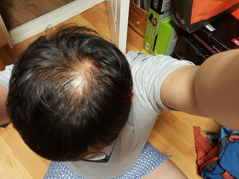 Propecia 5个月后期