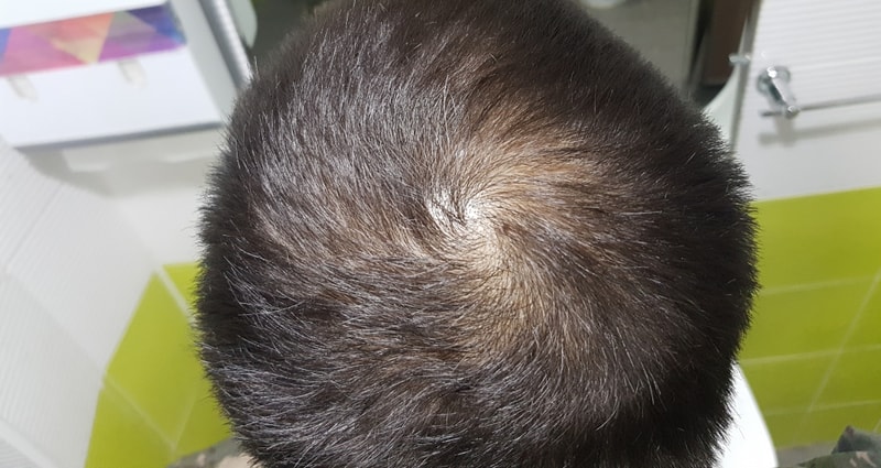 두타9개월 프로스카9개월.. 어떤가요 봐주십쇼