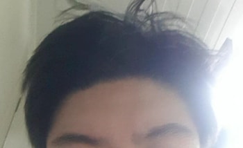 앞머리올린사진입니다. M자탈모도 꽤나호전이된것같습니다.