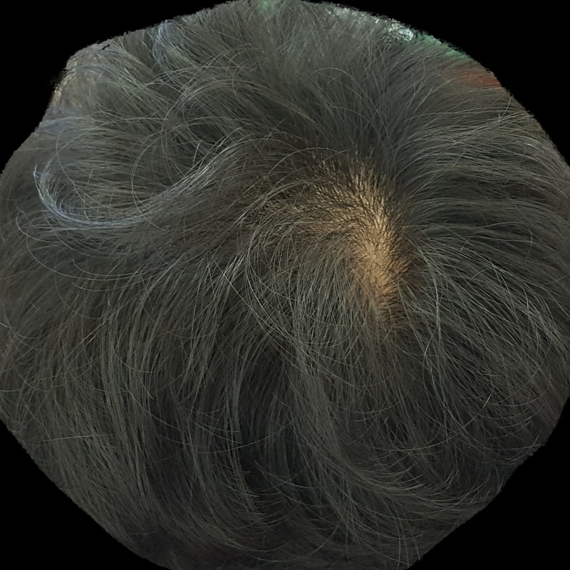 핀페시아 미녹시딜 9주차 후기