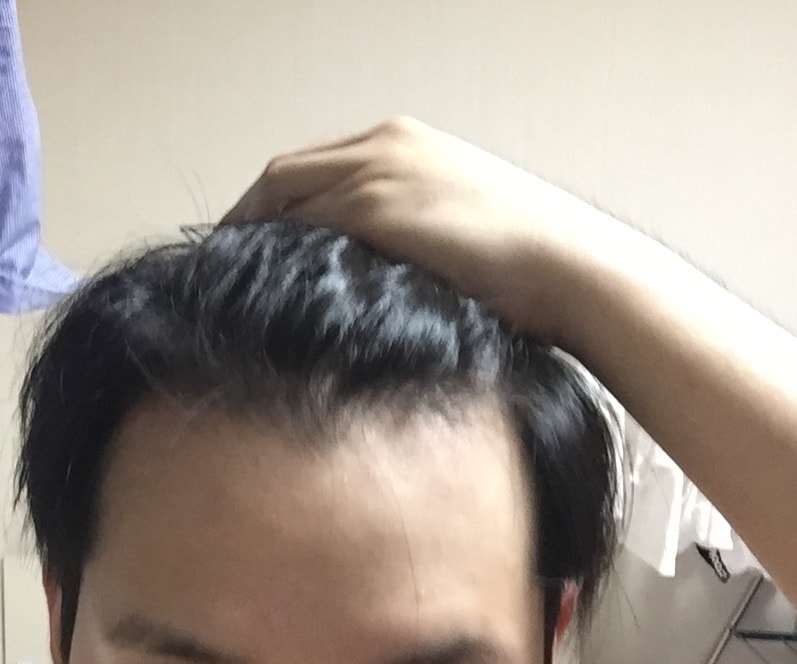 아보다트 1년 3개월 복용사진