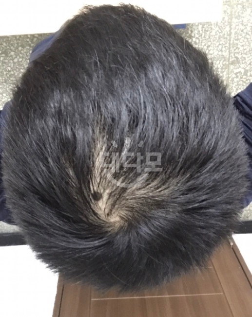 탈모로 고통받는 직업군인 프페 80일차 후기(일자별 사진 첨부)