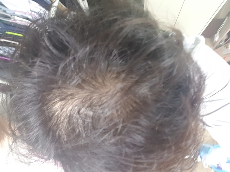 (Profesia + Minoxidil) Starts August 22nd to December 2nd