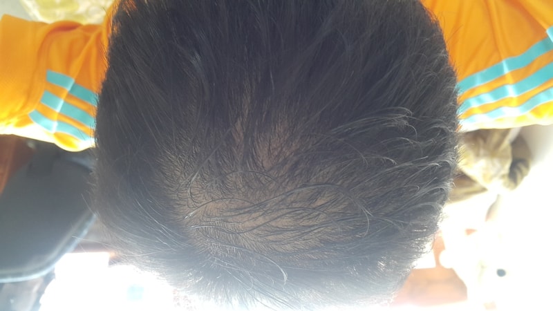 Pinasterid一年后期