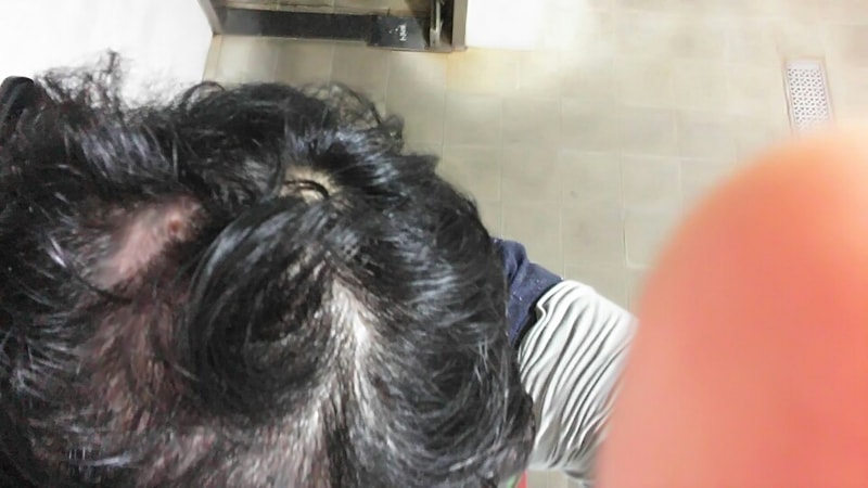 Minoxidil + Propecia 两个月后记