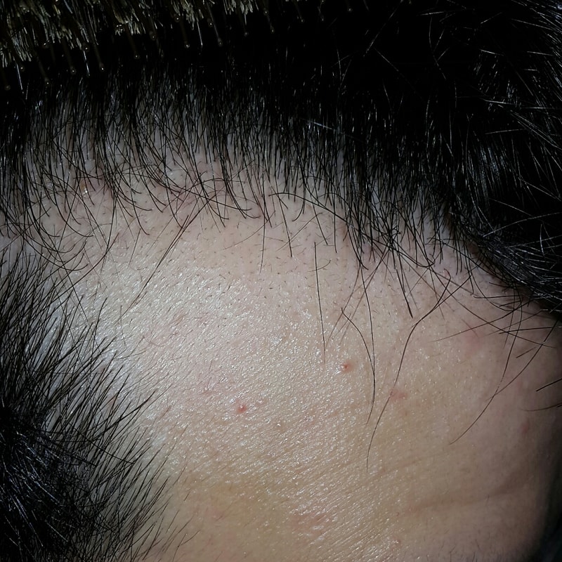 （propesia+elclanel）时隔1年和6个月再次上传的后记