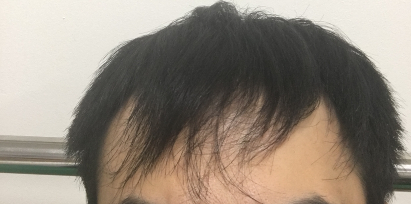 아보다트 복용전