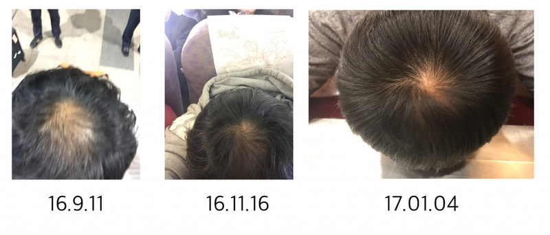 프로페시아 5개월 복용.