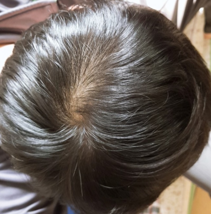 Comparison of the crown of the 74th day of taking the Pinasteride series