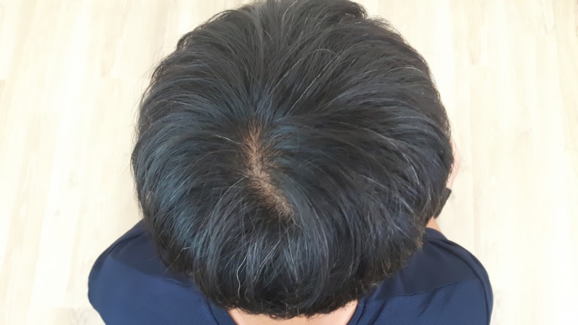 프로스카 10개월