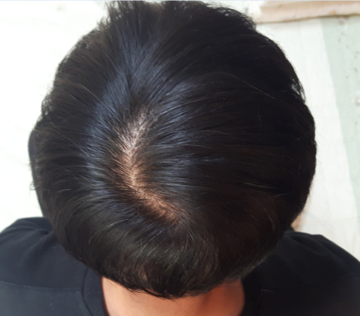 프로스카1년, 로게인폼1일