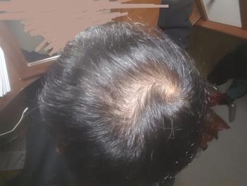 프페 4개월차, 미녹시딜 시작전