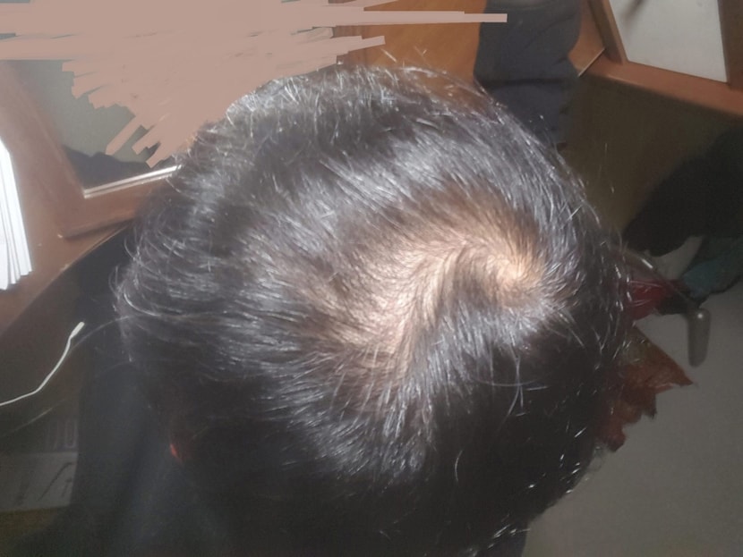 프페 4개월차, 미녹시딜 시작전