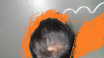 현재(프페 9개월 + 미녹5달)