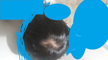 현재(프페 9개월 + 미녹5달)