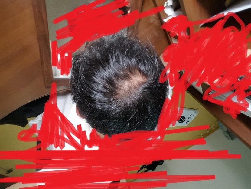 현재(프페 9개월 + 미녹5달)