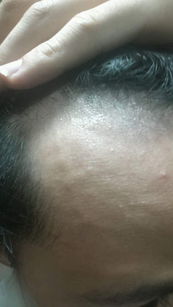 米诺地尔+贝雷帽精 1mg 第5天