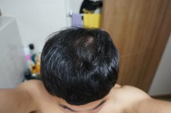 복용전 정수리