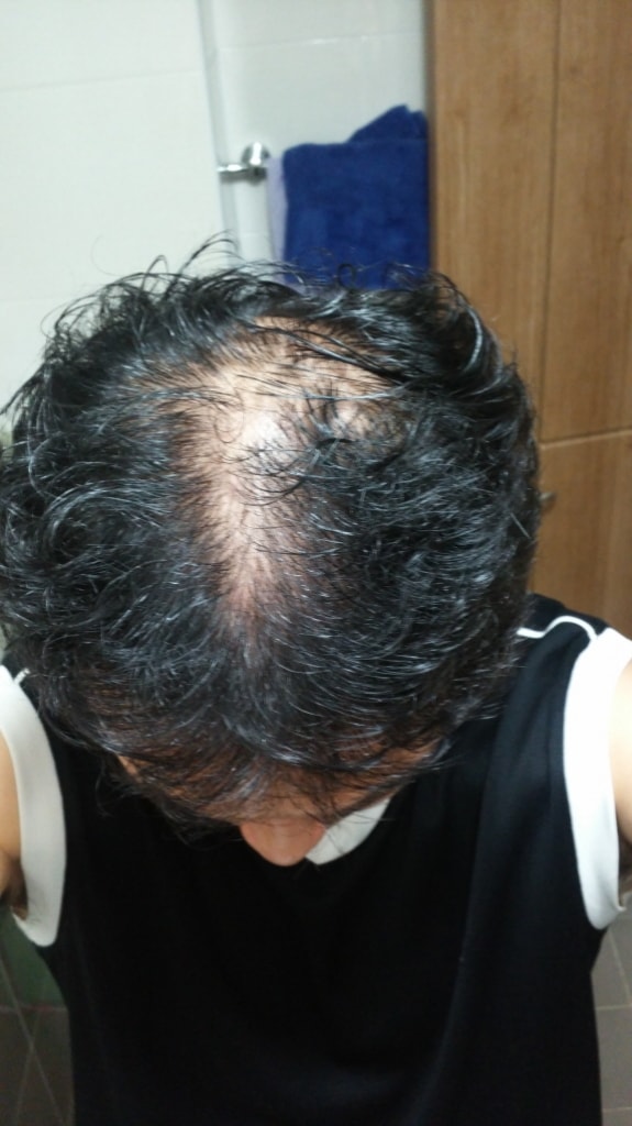 08/15 미녹바른후 (쉐딩현상 가장심할때 ㅠㅠ)