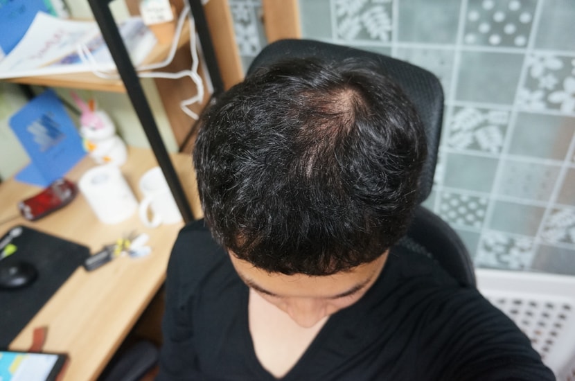 50일 복용후 정수리
