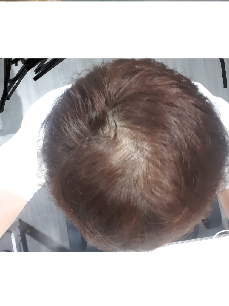 아보다트 8개월