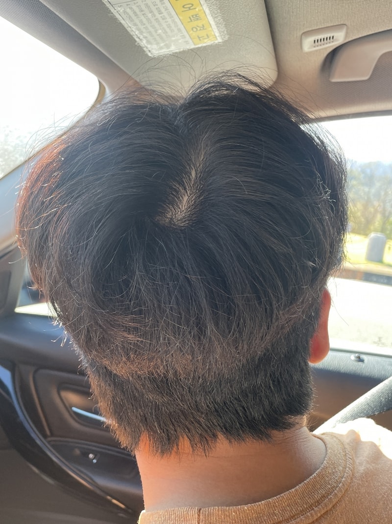 탈모 극복했어요! 그 이유 분석해서 올립니다