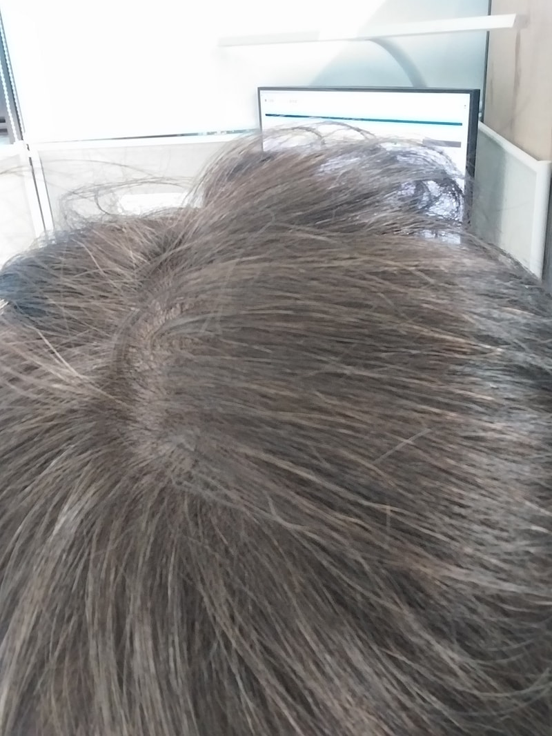 알로스칸+판토모나 2년차입니다.