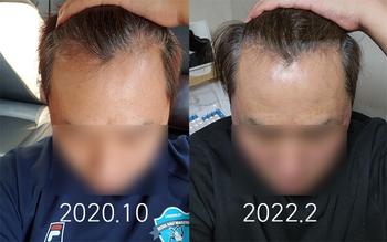 약 복용 전 좌측 사진과 현재 우측 사진