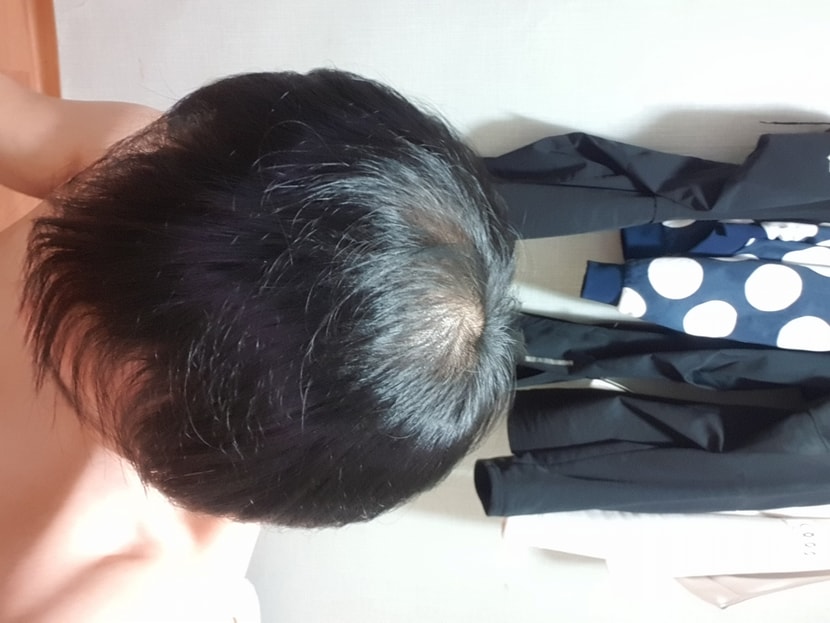 머리 쉐딩 현상으로 털렸을때