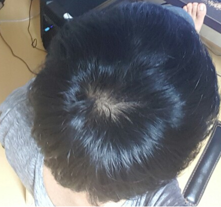 프로페시아 116일째..