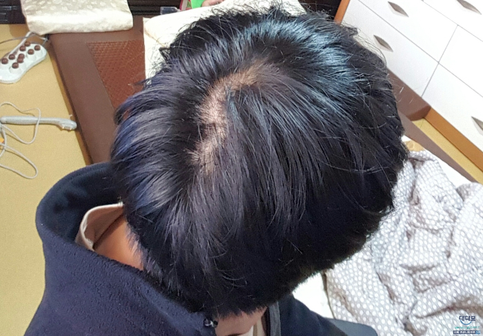 복용초반(16일째때) 정수리길 만들어보고 찍은사진