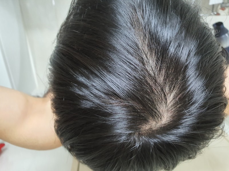 피나 2년 먹다가 최근 두타로 갈아탄지 6개월 정도..