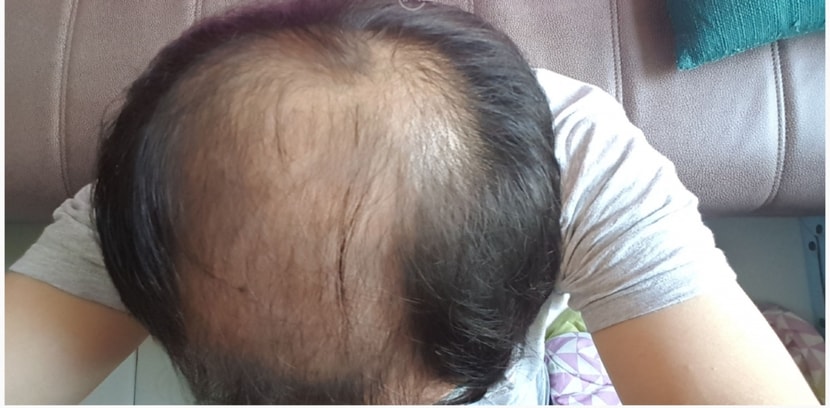 작년 12월 약 복용전