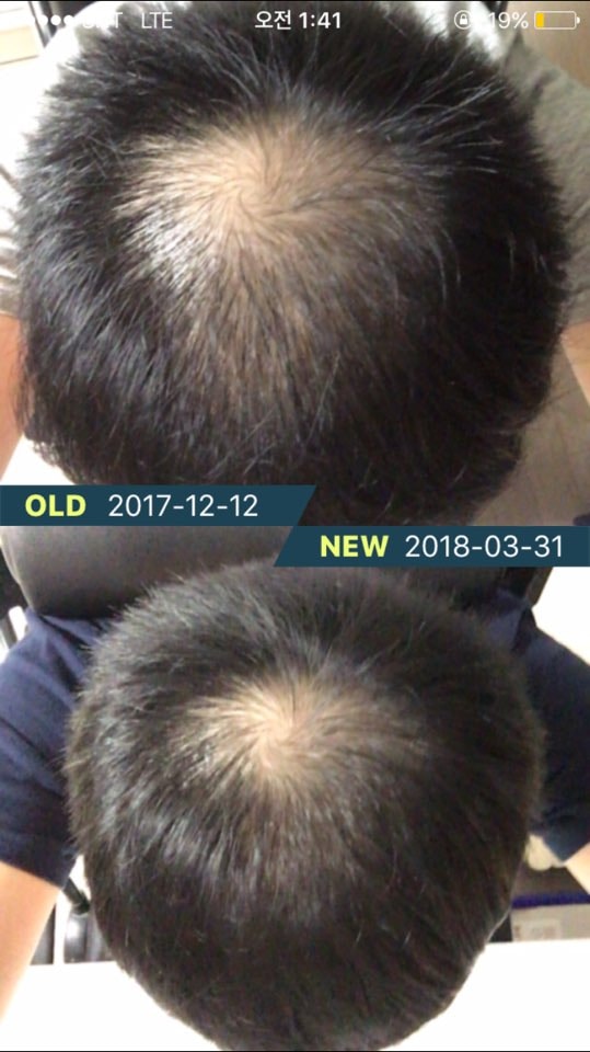 Comparison of topical hair loss avodat and propecia