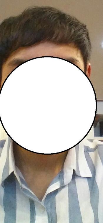 이 사진이 프로페시아 초기입니다. (2015년 여름)