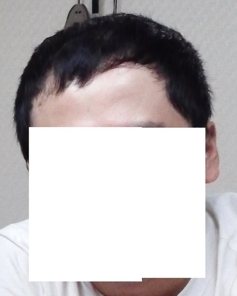 《非那斯特里德》第1年零8个月后期。