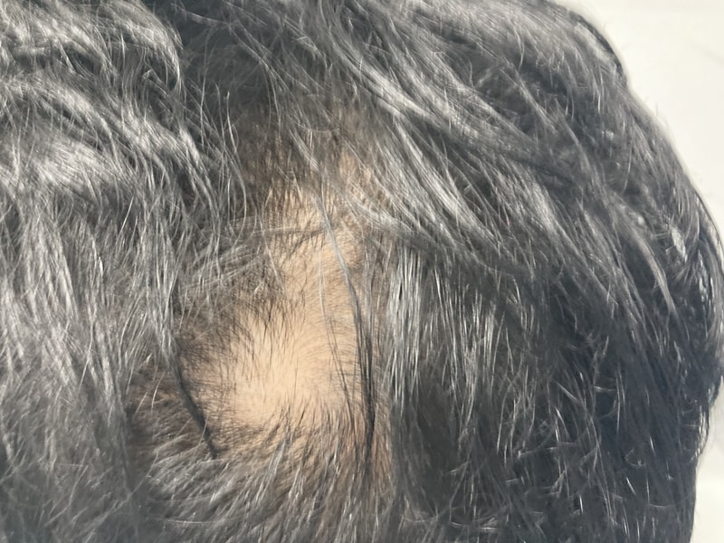I started my hair loss medicine when I was 49 years old