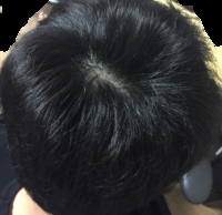 안녕하세요 프로페시아 카피약 8개월째 복용중인 20대 남자입니다.